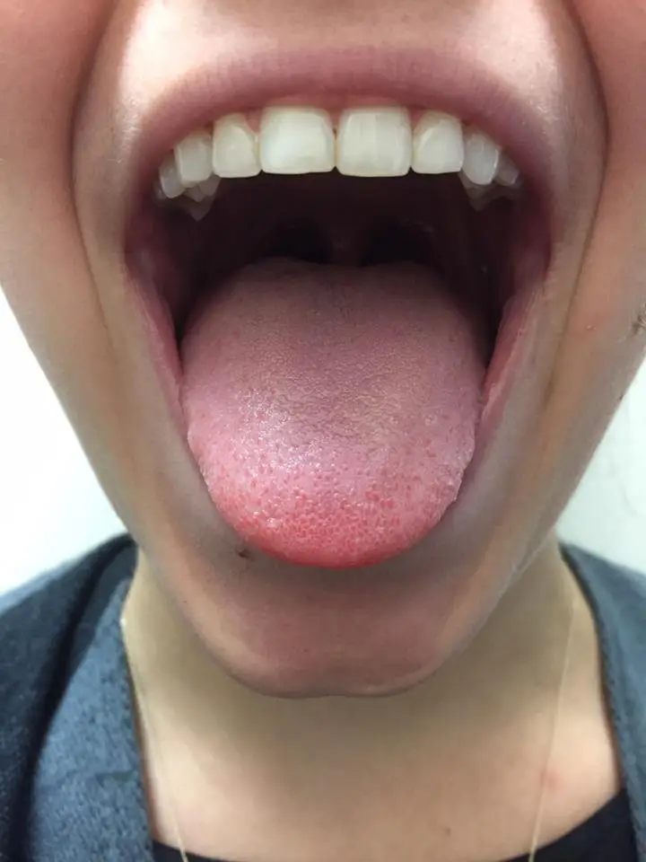 Chiropractic Ottawa ON Tongue