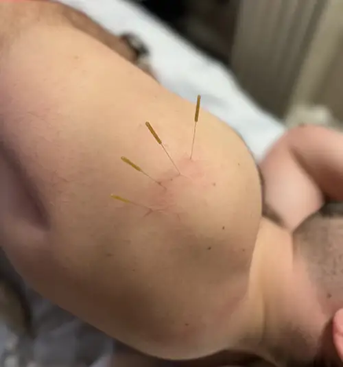 Chiropractic Ottawa ON acupuncture needles