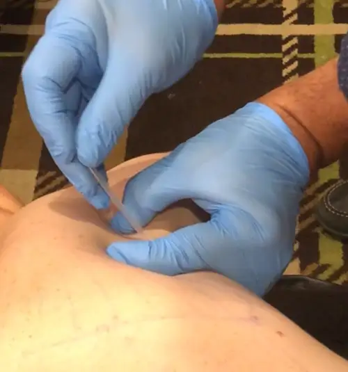 Chiropractic Ottawa ON dry needling